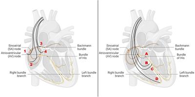 Pacemaker-induced atrial fibrillation reconsidered—associations with different pacing sites and prevention approaches